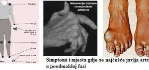 12. oktobar – Svjetski dan borbe protiv reumatoidnog artritisa