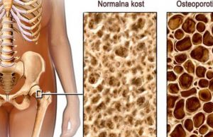 20. OKTOBAR – SVJETSKI DAN BORBE PROTIV OSTEOPOROZE