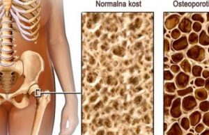 20. OKTOBAR – SVJETSKI DAN BORBE PROTIV OSTEOPOROZE