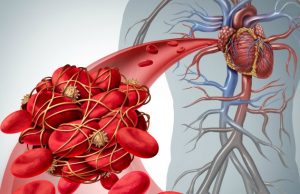 13. oktobar – Svjetski dan tromboze